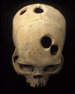 A human skull with several round holes cut into it by trepanning